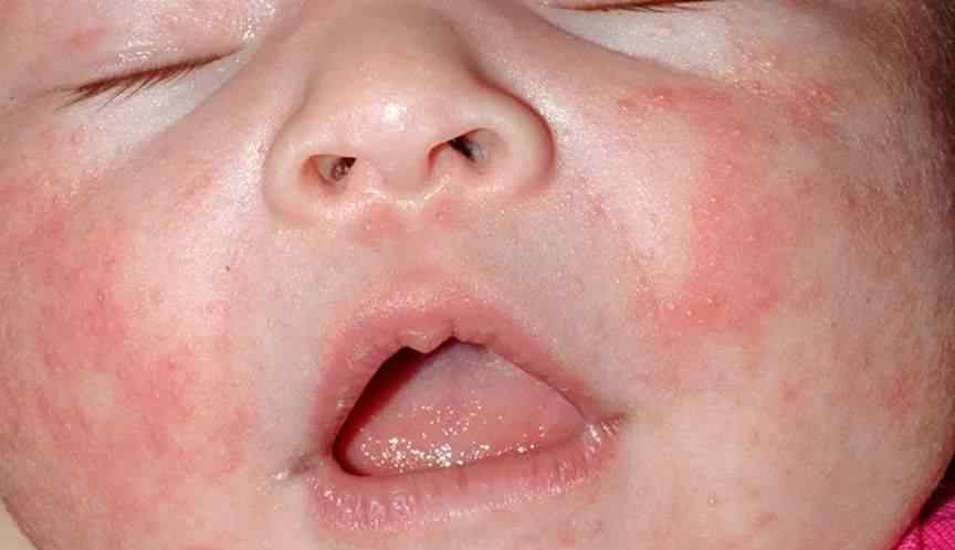 婴儿痤疮图片 图文并茂，掌握新生儿痤疮的鉴别诊断