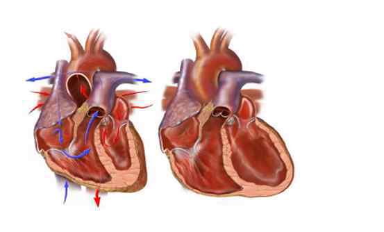 病毒性心肌炎后遗症 病毒性心肌炎有后遗症吗 病毒性心肌炎应该怎么治疗呢