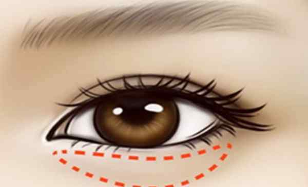什么是超声法去眼袋 超声波去眼袋的优势 超声波去眼袋适合什么人群