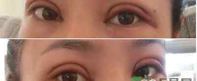 双眼皮恢复过程图 定点双眼皮恢复过程图_定点双眼皮要多久恢复