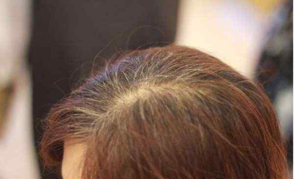 预防白发 白头发是怎样引起的 怎样预防白头发