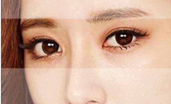 韩式切开双眼皮 韩式三点双眼皮与全切双眼皮有什么不同 各有优缺点
