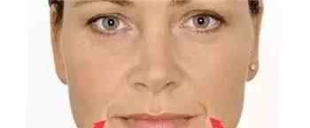 嘴角纹 嘴角纹是什么?嘴角纹是怎么形成的?