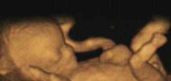 胚胎放入子宫游走图片 胎儿在子宫的睡姿