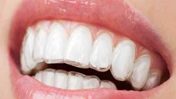 隐形牙箍 隐形牙箍的原理 隐形牙套的优点