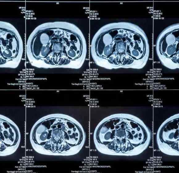快速学肺ct片子怎么看 医生拿着 CT 片子都看了些什么？我怎么看不出来？