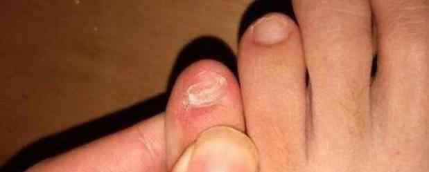 小拇指甲两瓣科学解释 为什么很多中国人小脚趾甲是两瓣的？没想到其中有这样的讲究！