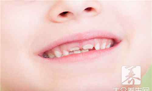 婴儿乳牙黄斑图 婴儿乳牙黄斑图